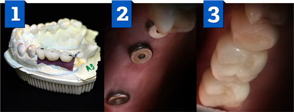 dental implants by cyprus dental clinic Vident